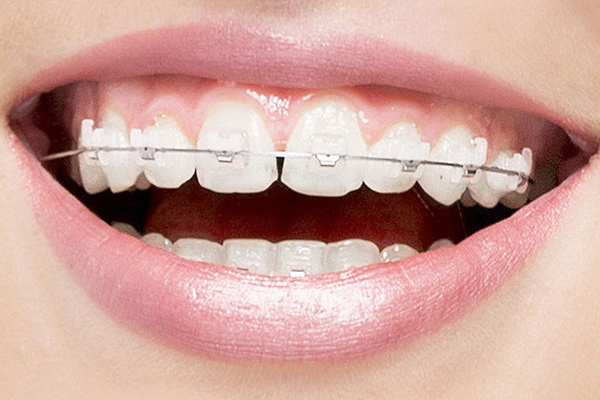 Are Clear Braces a Popular Option for Teeth Straightening? - Palm Beach  Dentistry Delray Beach Florida
