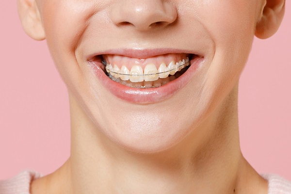 How To Maintain Your Oral Health With Clear Braces From A General Dentist