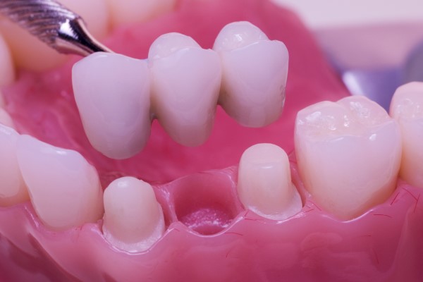What is the Best Material for Fixed Dental Bridges? – Totally Dental